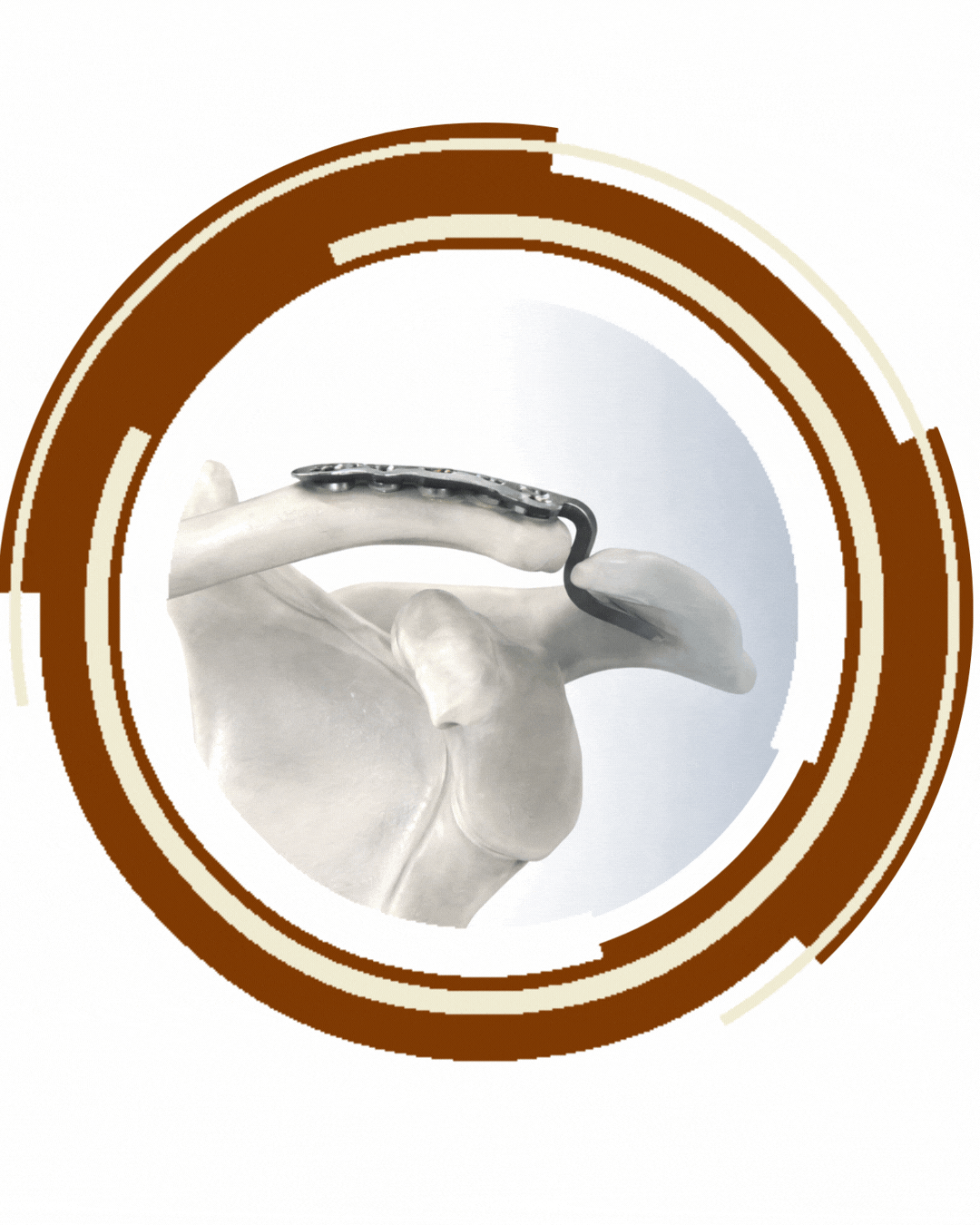 Orthopaedic Trauma Implants