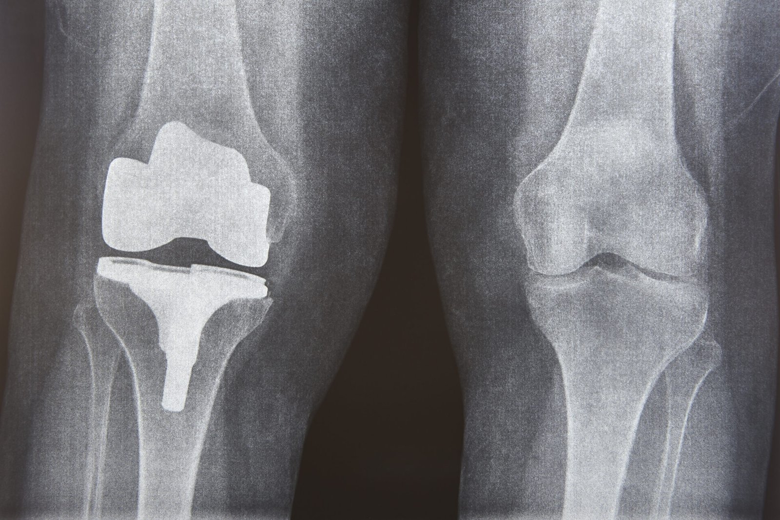 Knee Replacement